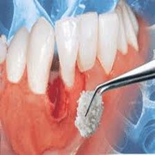 الطعوم العظمية للأسنان والأغشية